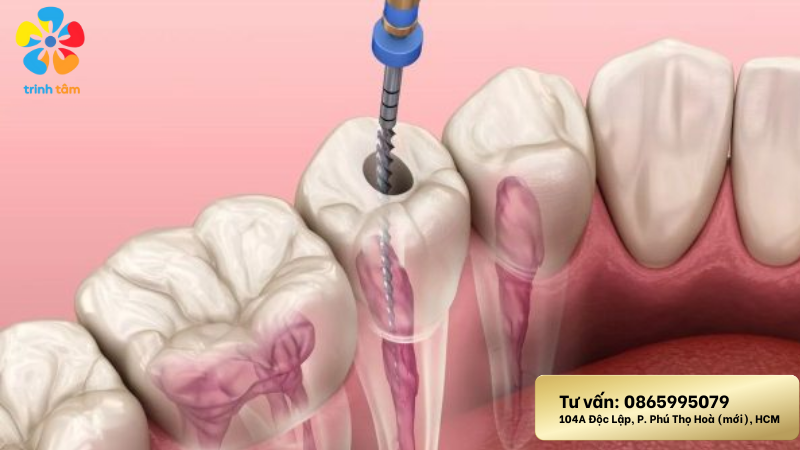 chữa tủy sâu răng