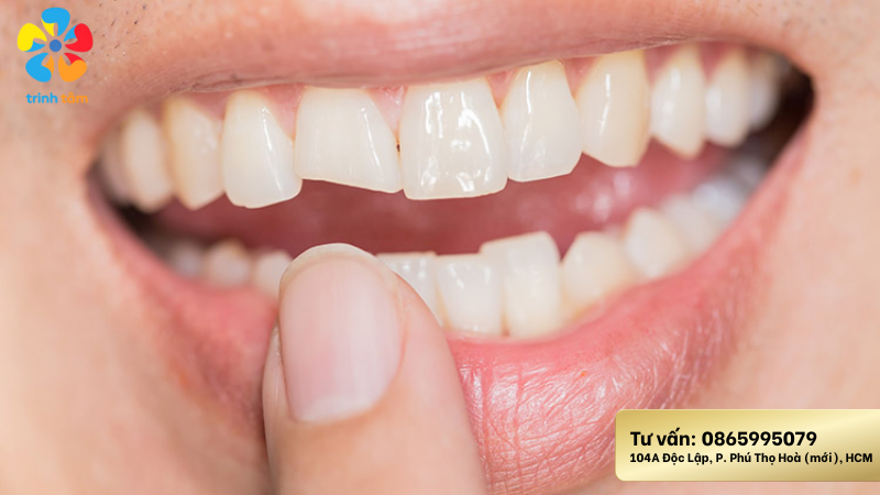 Răng sứ bị mẻ cách khắc phục như thế nào?