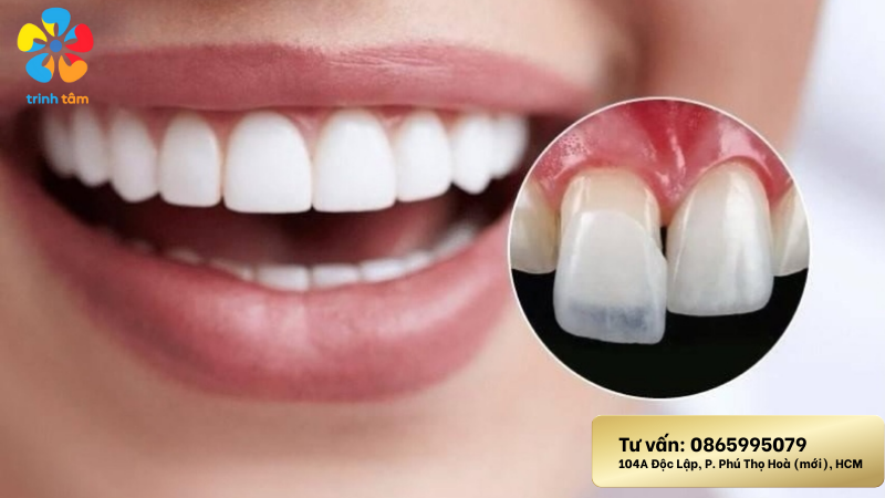 Dán sứ veneer – giải pháp thẩm mỹ cho răng hiện nay