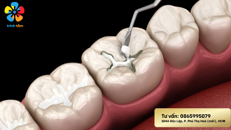 trám răng sâu