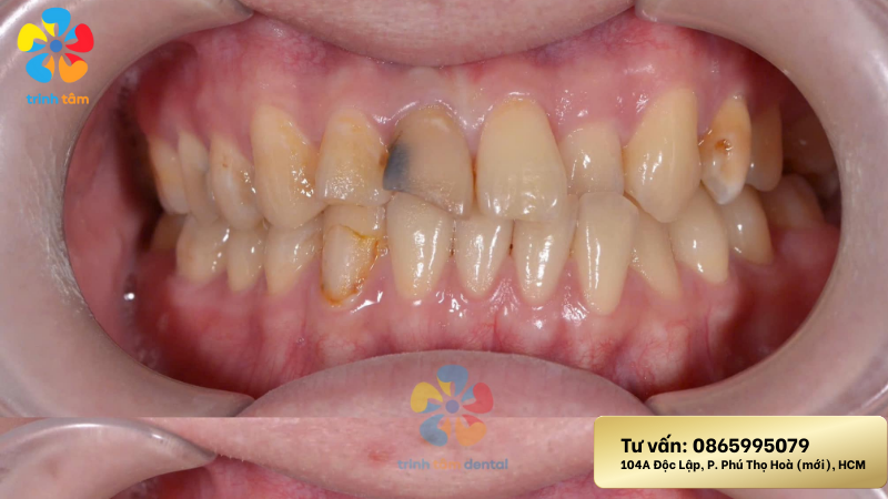 bọc mão răng sứ