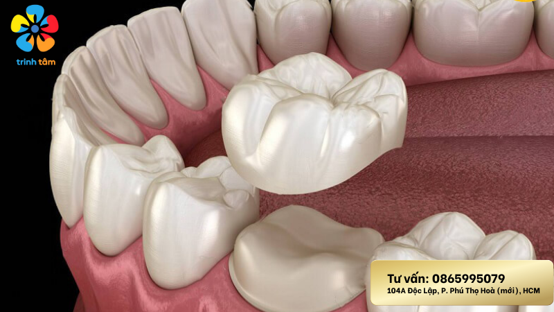 sâu răng hàm dưới