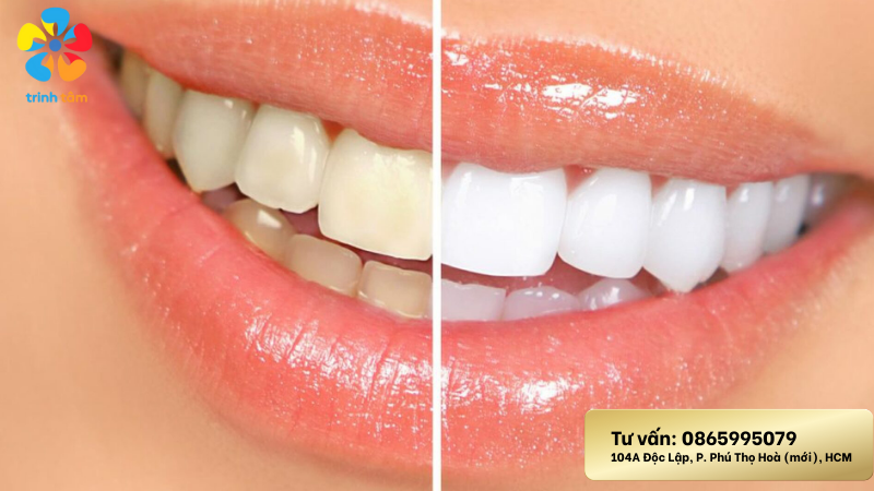 bọc mão răng sứ