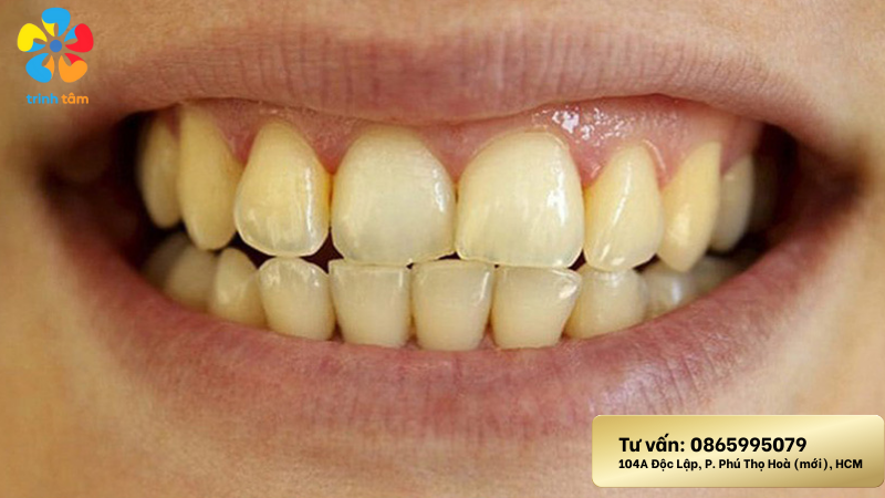 làm trắng răng