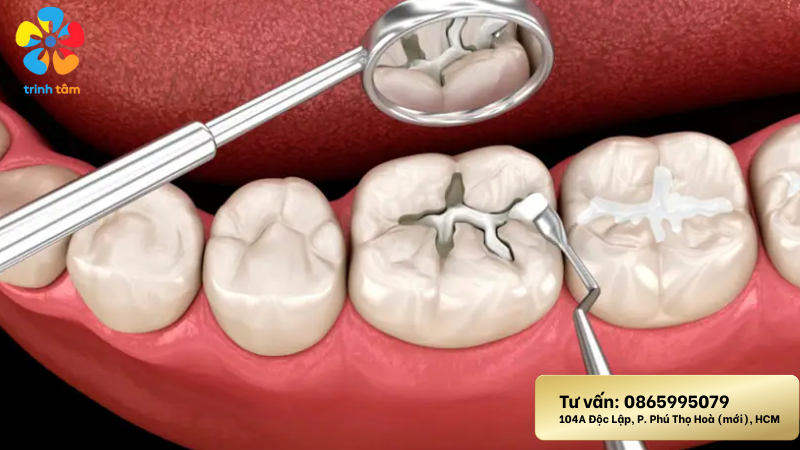 sâu răng hàm dưới