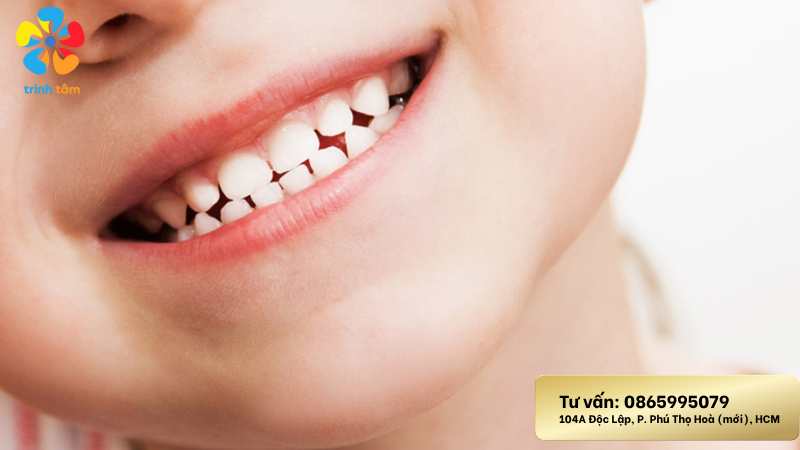 Răng sữa có trám được không | Trám răng sữa giá rẻ có tốt không?