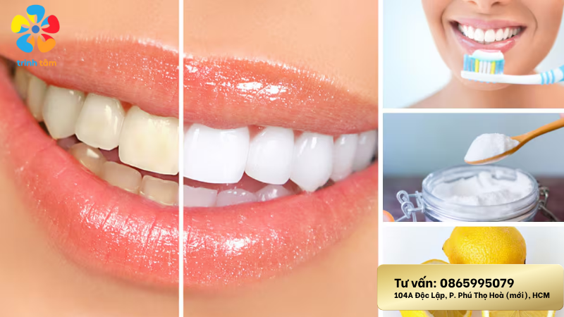 tẩy trắng răng
