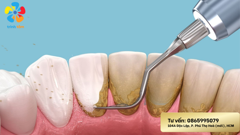 răng bị đen mặt trong