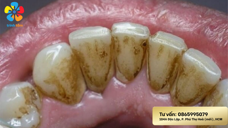 Răng bị đen ở mặt trong