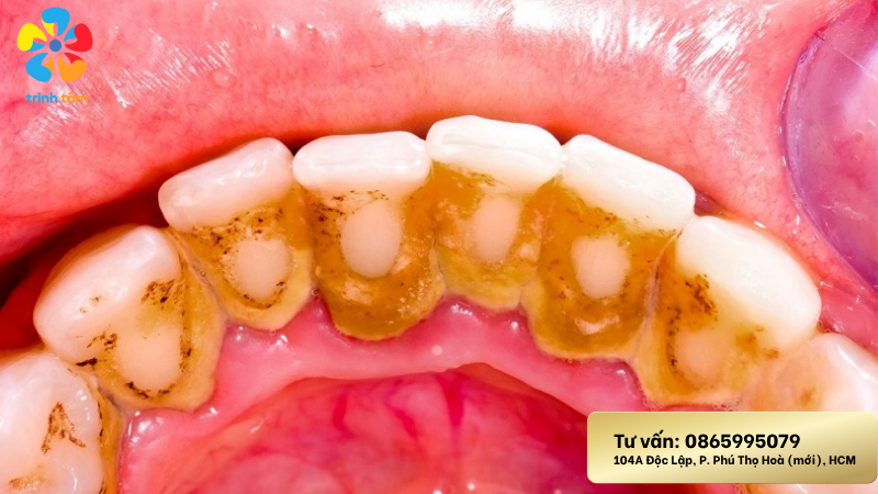 Răng đen mặt trong cách điều trị | Cạo vôi răng giá rẻ