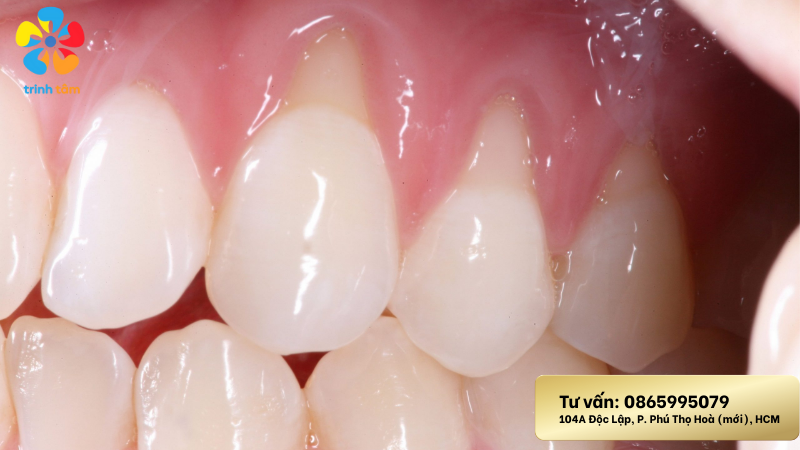 trám mòn cổ chân răng