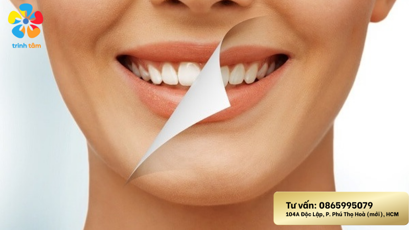 tẩy trắng răng