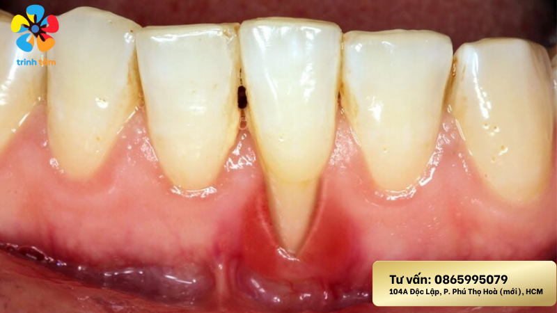 răng tụt lợi