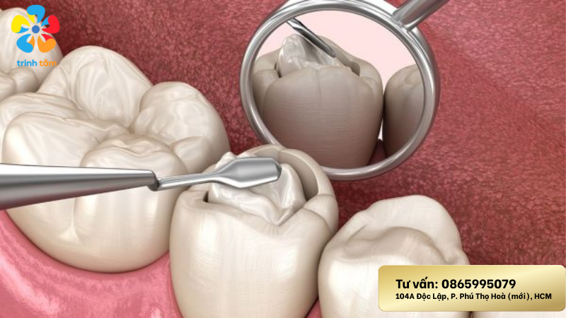 điều trị sâu răng