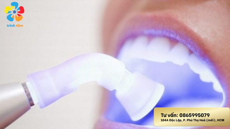 Tẩy trắng răng giá rẻ: TOP 5 phương pháp hiệu quả