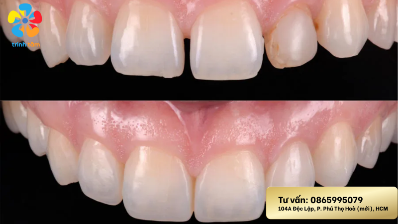 Trám răng cửa thưa được không? | Trám răng Tân Phú