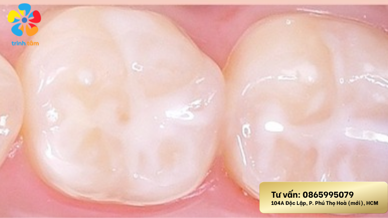 điều trị răng sâu