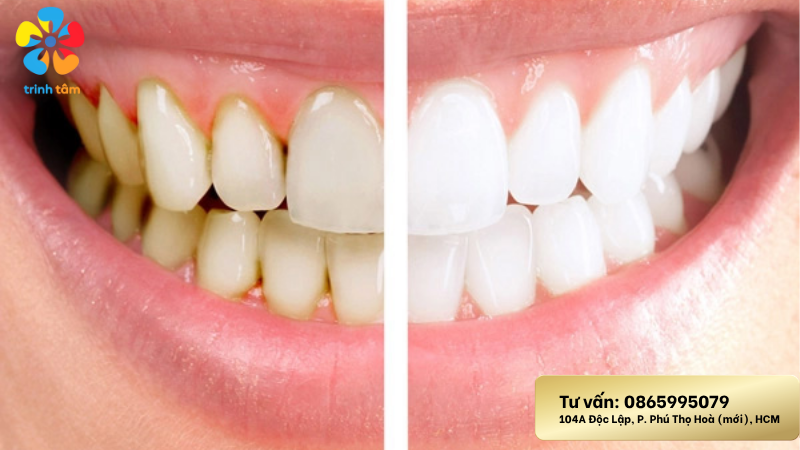 làm sạch mảng bám