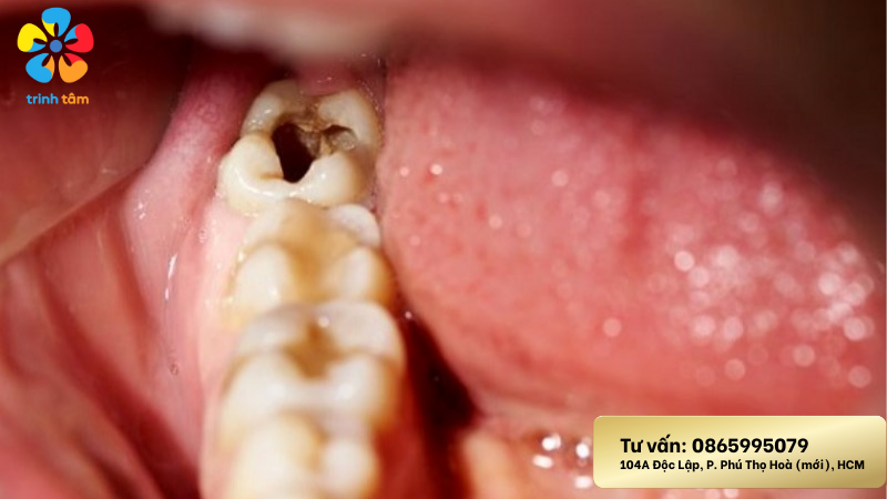 Sâu răng nhẹ đánh răng hết không?| Trám răng giá rẻ