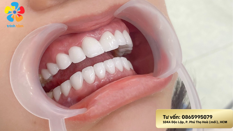 Bọc sứ giá rẻ Tân Phú| Chăm sóc răng sau khi bọc sứ