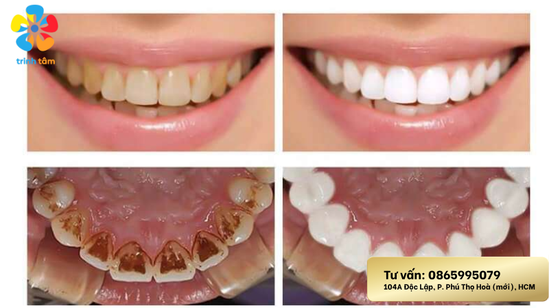 Tẩy trắng răng chuyên nghiệp