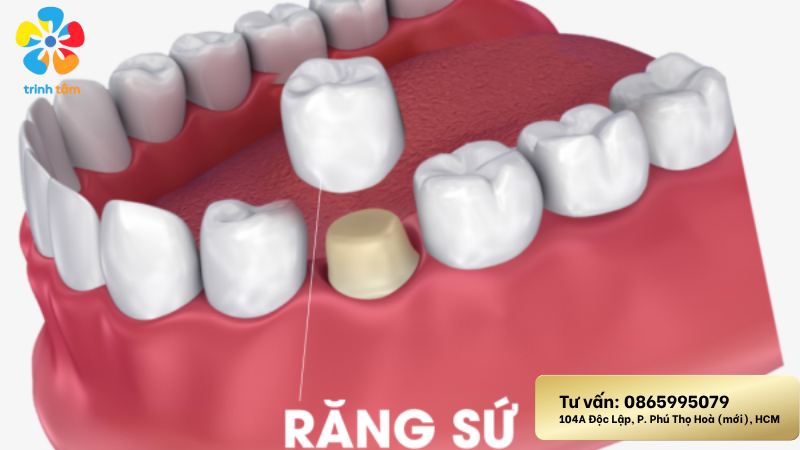 làm răng sứ thẩm mỹ