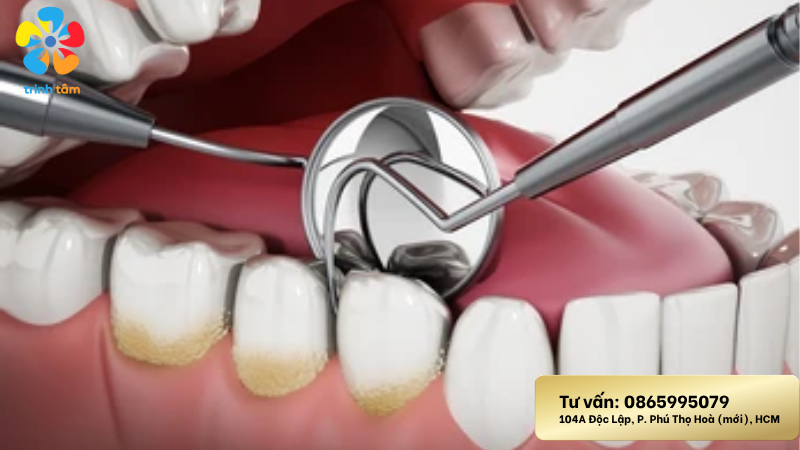 Lấy Cao Răng Không Đau Tại Nha Khoa Trinh Tâm