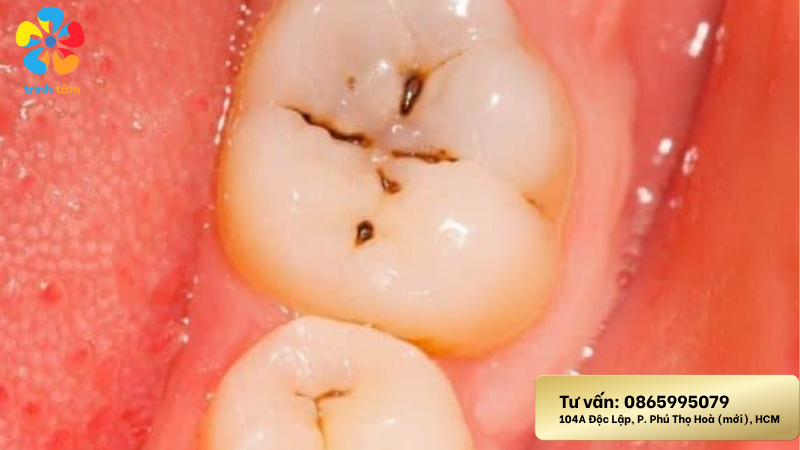 chữa sâu răng
