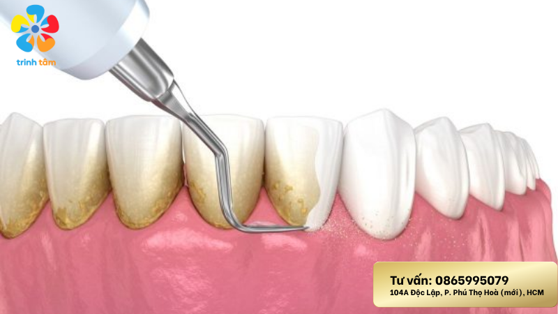 Lấy cao răng cho trẻ được không?| Lấy cao răng giá rẻ