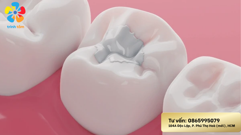 Điều trị răng sâu ở trẻ tại Nha khoa Trinh Tâm
