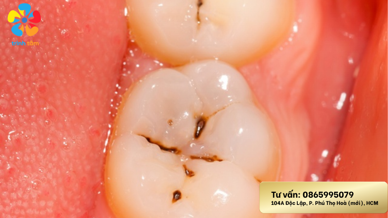 điều trị răng sâu