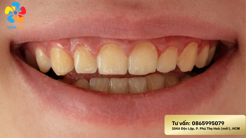 làm sáng răng