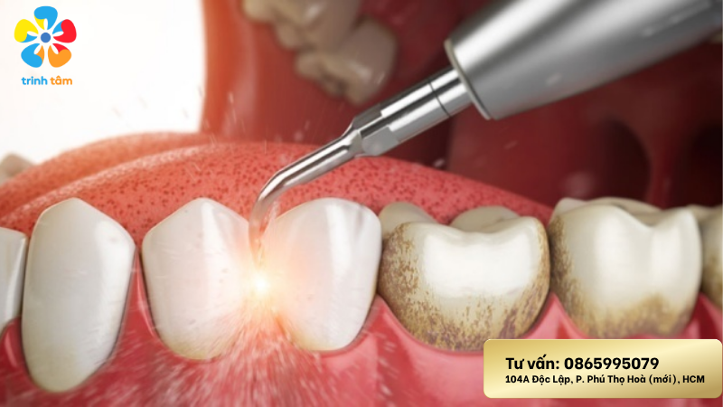 lấy cao răng không đau