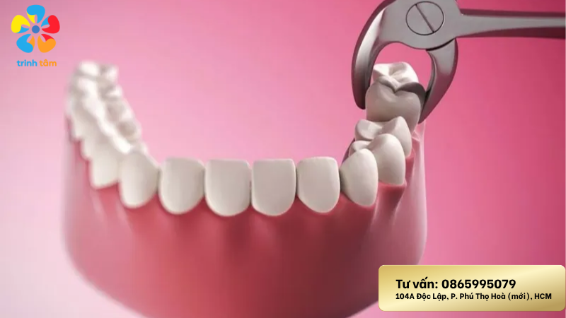 Nhổ răng khôn không đau giá rẻ tại Nha khoa Trinh Tâm