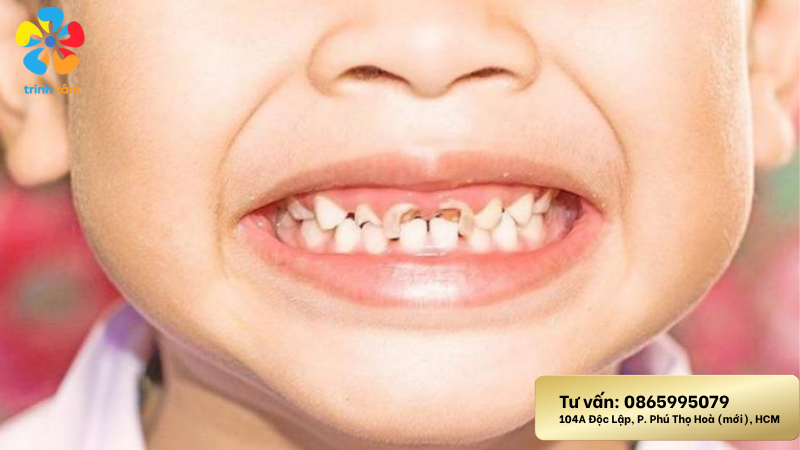 điều trị răng sâu