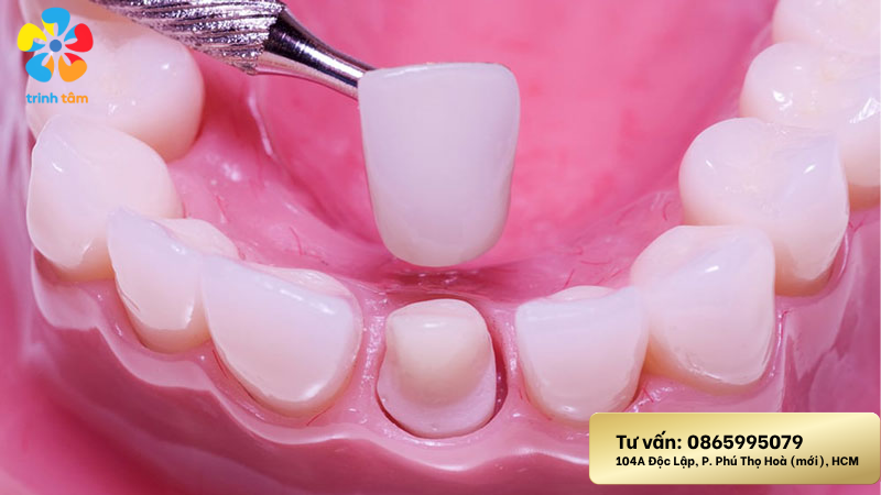 Bọc răng sứ bị ê buốt
