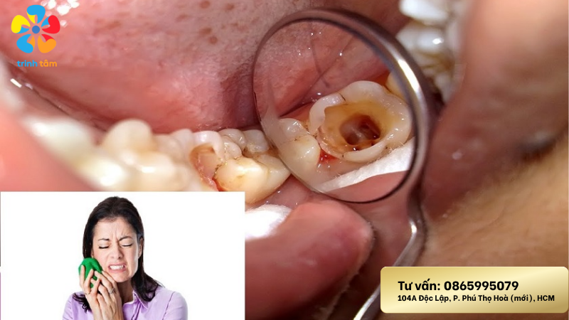 Chữa sâu răng tận gốc