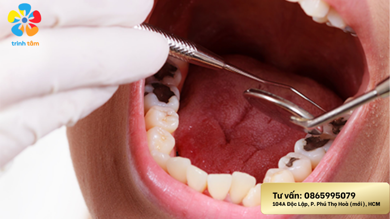 Điều trị hôi miệng tận gốc