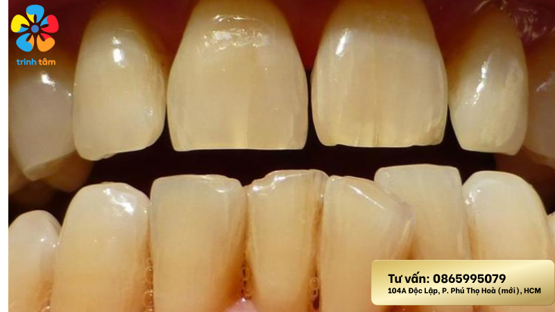 Tẩy trắng răng không buốt 