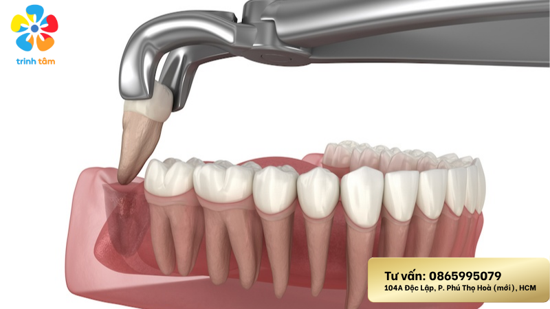 Nhổ răng khôn giá rẻ Tân Phú | Quy trình nhổ răng khôn