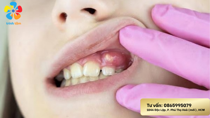 viêm nướu