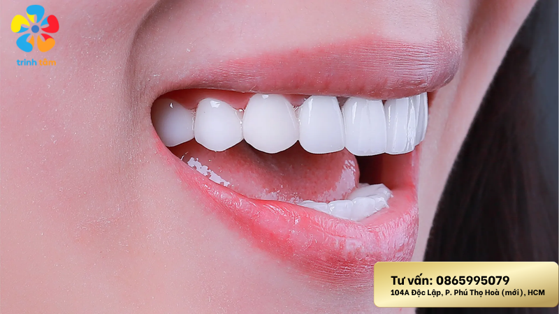 tẩy trắng răng an toàn