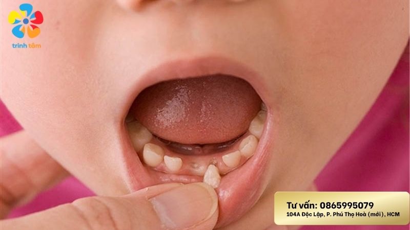 Nhổ răng sữa có đau không