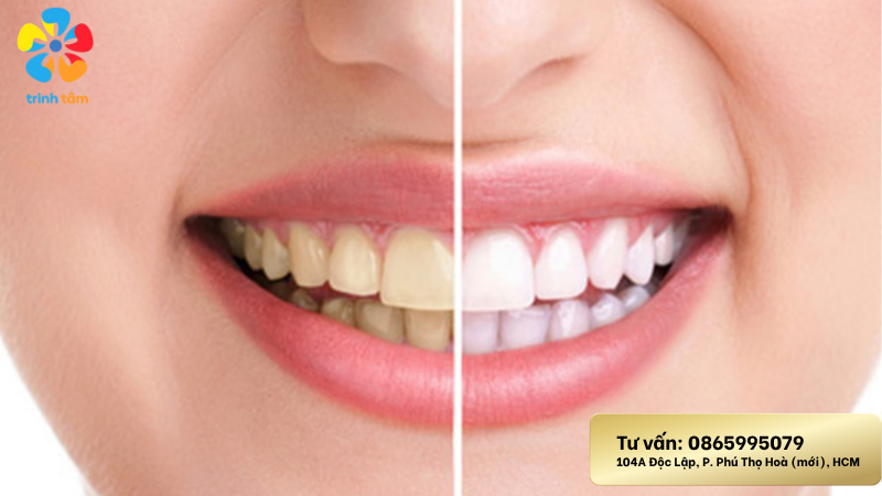 bọc răng sứ ố vàng