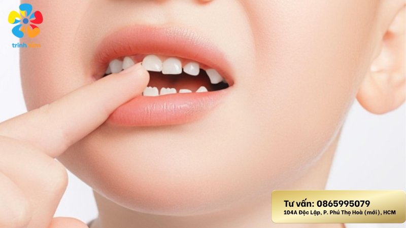 chấn thương răng sữa
