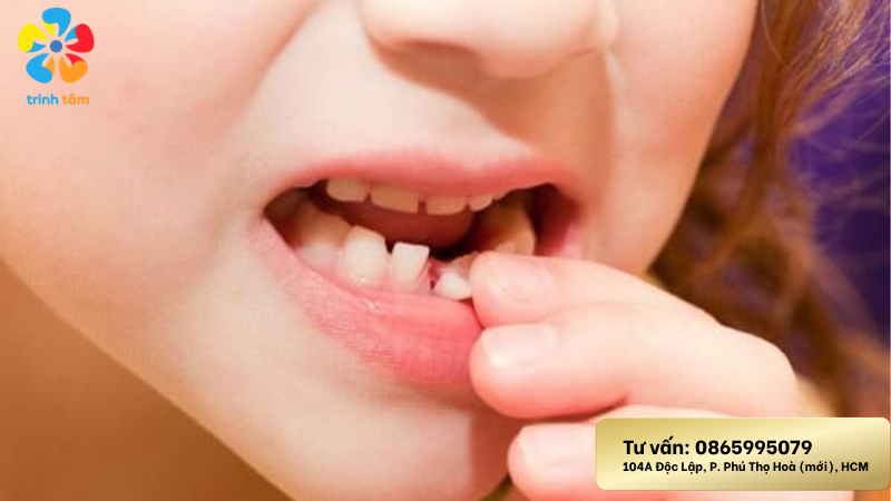 Răng sữa bị chấn thương ở trẻ | Nha khoa trẻ em giá rẻ