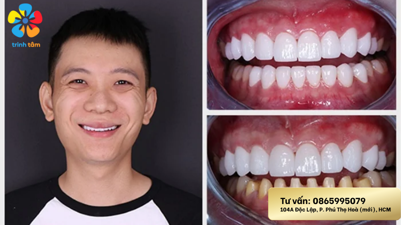 feedback bọc răng sứ