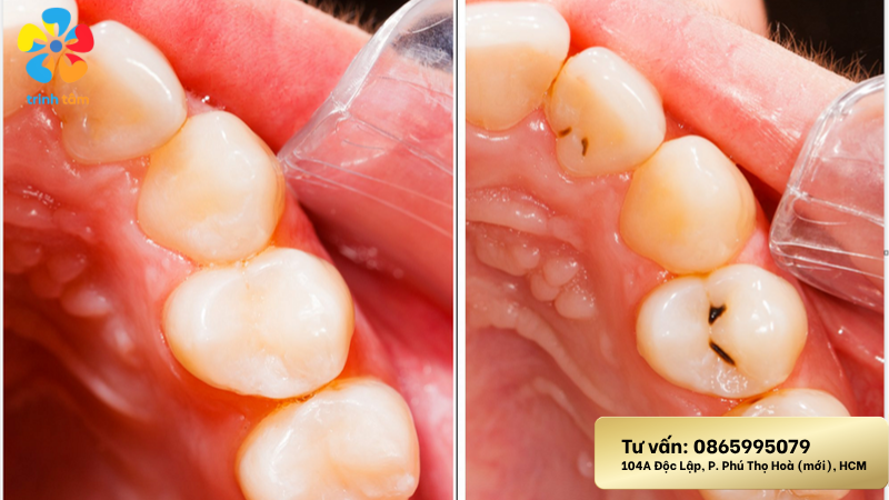 Răng sữa sâu nên nhổ không | Nhổ răng sữa giá rẻ