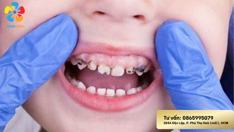Trẻ bị sâu răng hàm