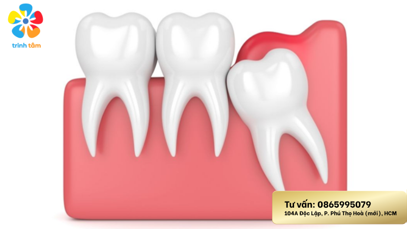 Lợi trùm răng khôn là gì | Cách trị lợi trùm răng khôn